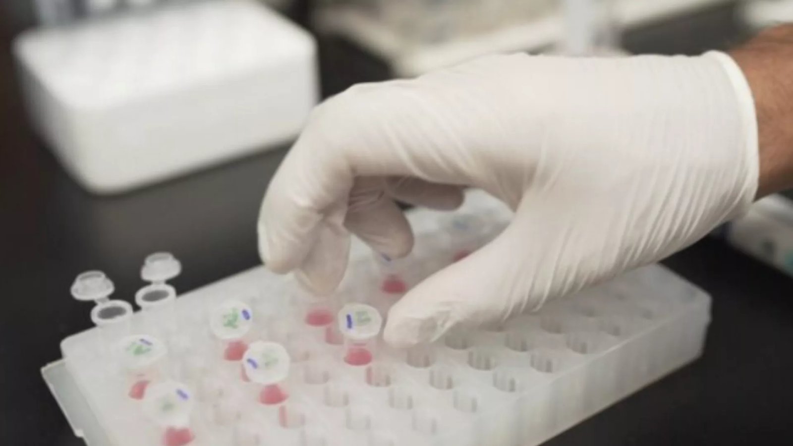 Alzheimer Teşhisinde Çığır Açan Kan Testi Geliştirildi